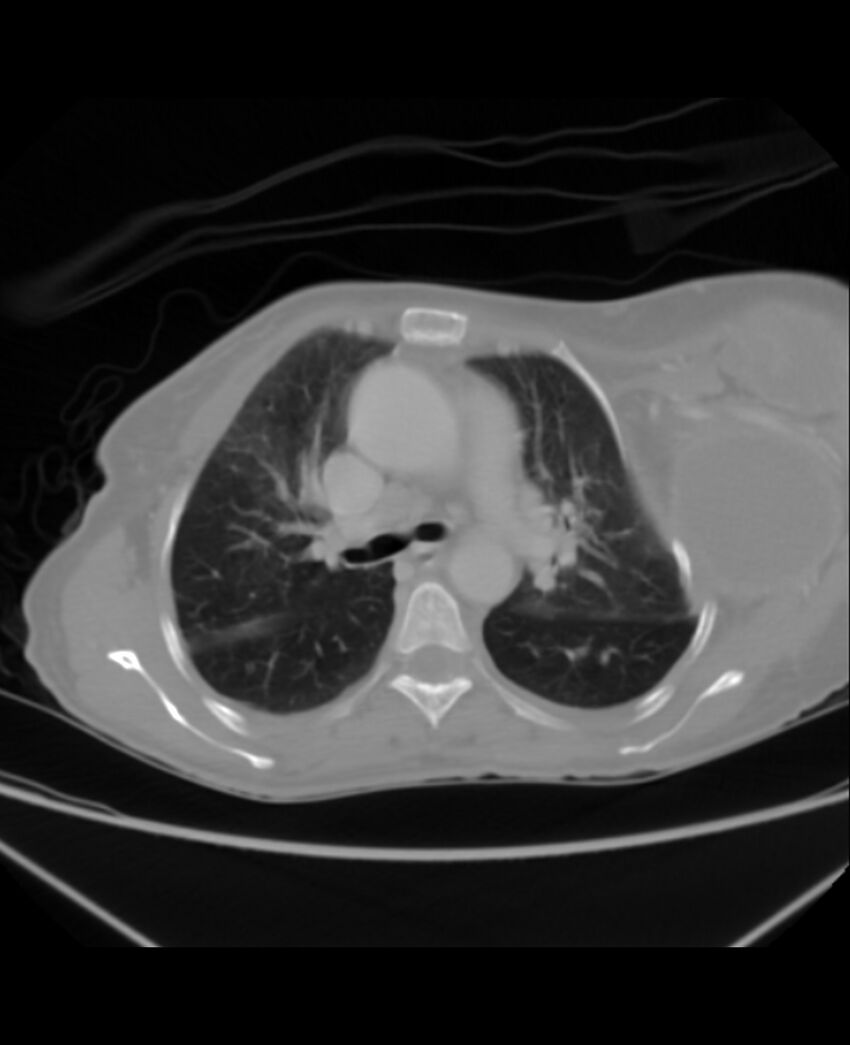 Chondrosarcoma (Radiopaedia 79427-92535 Axial lung window 19).jpg