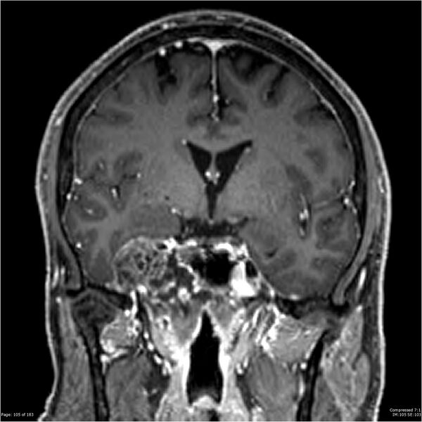 File:Chondrosarcoma of skull base- grade II (Radiopaedia 40948-43654 Coronal T1 C+ 16).jpg