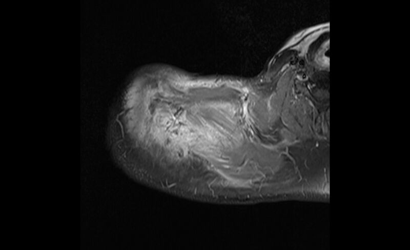 File:Choriocarcinoma in the shoulder (Radiopaedia 28603-28861 Axial T1 C+ fat sat 4).jpg