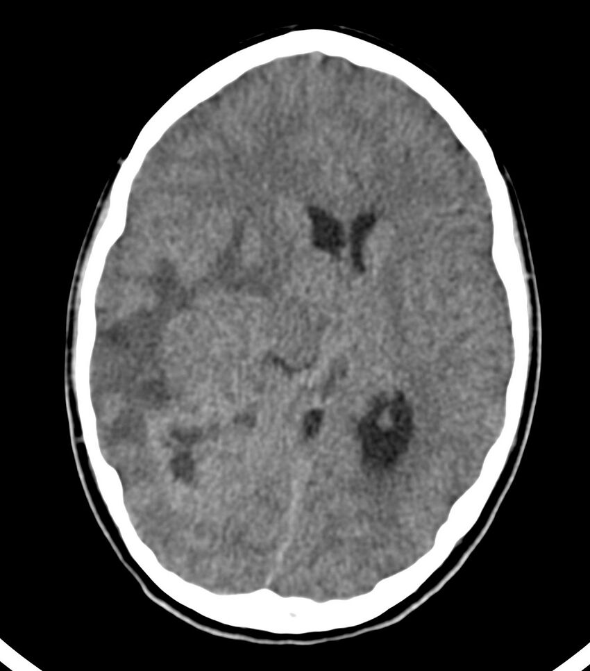 Choroid plexus carcinoma (Radiopaedia 91013-108552 Axial non-contrast 32).jpg