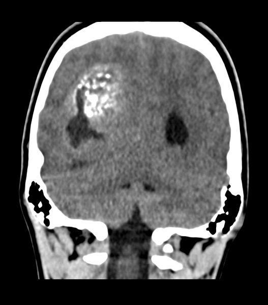 File:Choroid plexus carcinoma (Radiopaedia 91013-108552 Coronal non-contrast 64).jpg
