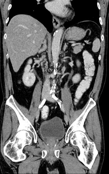 File:Chronic appendicitis complicated by appendicular abscess, pylephlebitis and liver abscess (Radiopaedia 54483-60700 C 46).jpg