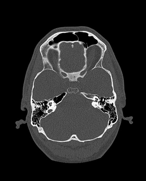 File:Chronic maxillary sinusitis caused by a foreign body (Radiopaedia 58521-65676 Axial bone window 251).jpg