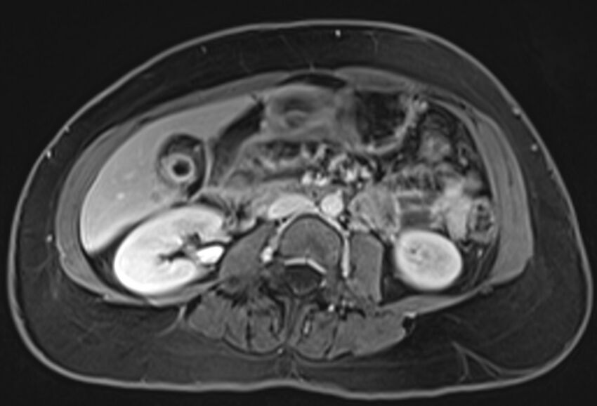 Chronic pancreatitis - pancreatic duct calculi (Radiopaedia 71818-82250 Axial T1 C+ fat sat 42).jpg