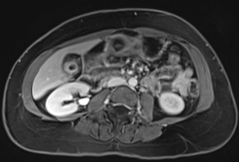 File:Chronic pancreatitis - pancreatic duct calculi (Radiopaedia 71818-82250 Axial T1 C+ fat sat 43).jpg