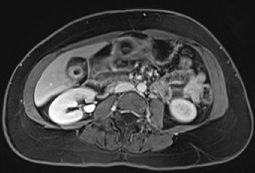 Chronic pancreatitis - pancreatic duct calculi (Radiopaedia 71818-82250 Axial T1 C+ fat sat 43).jpg