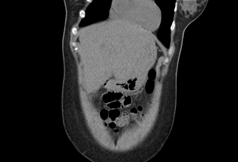 File:Chronic pancreatitis - pancreatic duct calculi (Radiopaedia 71818-82251 Coronal non-contrast 6).jpg