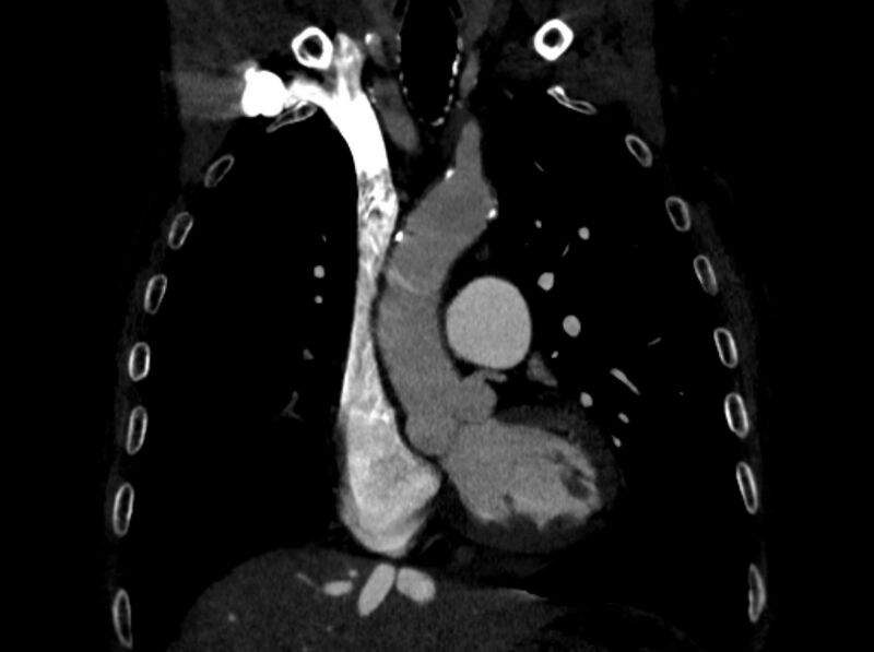File:Chronic pulmonary embolism (Radiopaedia 91241-108843 A 39).jpg