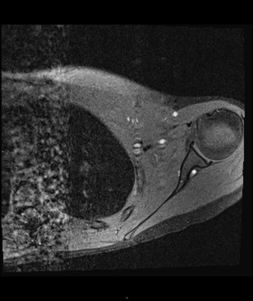 File:Chronic reactive multifocal osteomyelitis (CRMO) - clavicle (Radiopaedia 56406-63071 Axial T1 fat sat 17).jpg