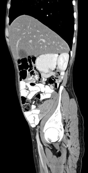 File:Chronic small bowel volvulus (Radiopaedia 75224-86322 C 110).jpg