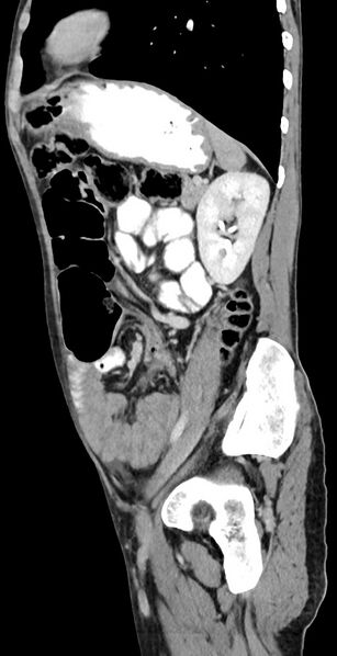 File:Chronic small bowel volvulus (Radiopaedia 75224-86322 C 49).jpg