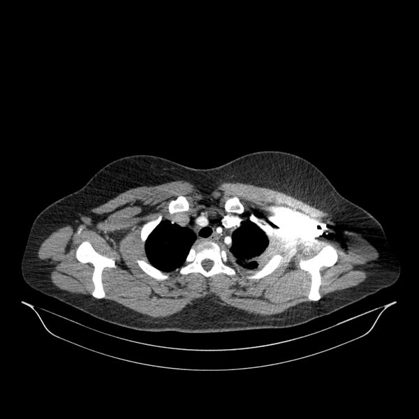 File:Chronic thromboembolic pulmonary hypertension (CTEPH) (Radiopaedia 74597-85532 Axial C+ CTPA 138).jpg
