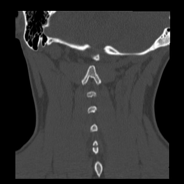 File:Clay-shoveler fracture (Radiopaedia 22568-22590 Coronal bone window 32).jpg