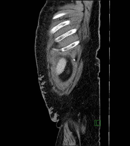 File:Closed-loop small bowel obstruction-internal hernia (Radiopaedia 78439-91096 C 18).jpg