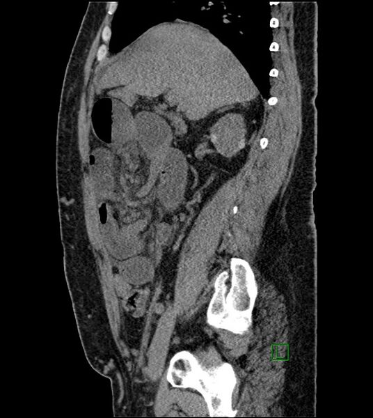File:Closed-loop small bowel obstruction-internal hernia (Radiopaedia 78439-91096 C 94).jpg