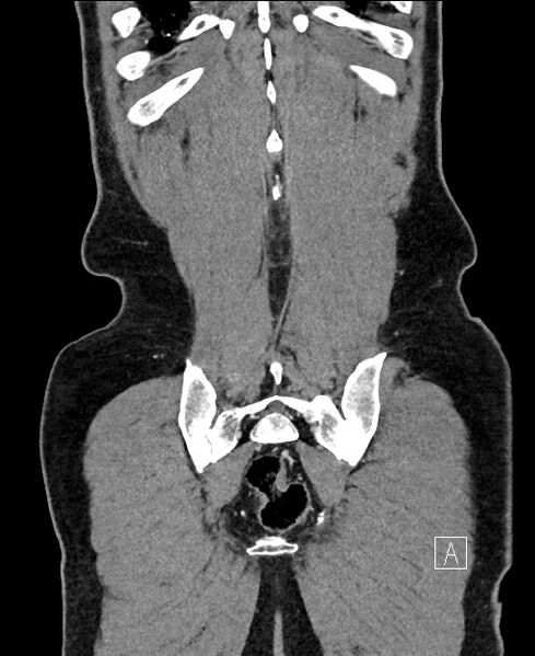 File:Closed loop small bowel obstruction - internal hernia (Radiopaedia 57806-64778 A 109).jpg