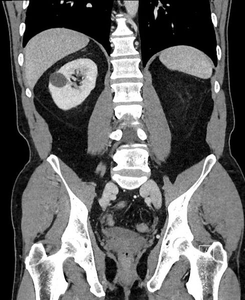 File:Closed loop small bowel obstruction - internal hernia (Radiopaedia 57806-64778 A 80).jpg