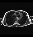 Coarctation of the aorta (Radiopaedia 43373-46729 Axial T2 18).jpg