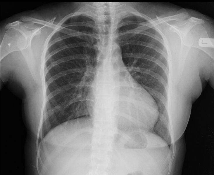 File:Coarctation of the aorta (Radiopaedia 43490).jpg