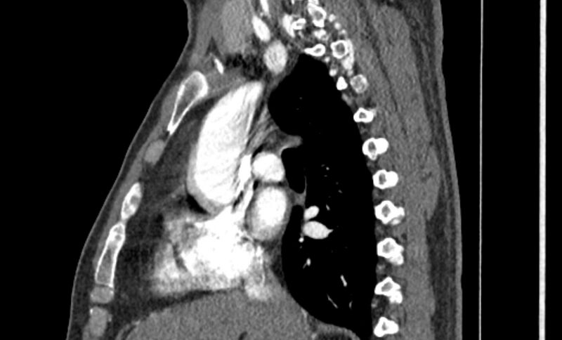 File:Coarctation of the aorta (Radiopaedia 53363-59343 B 22).jpg