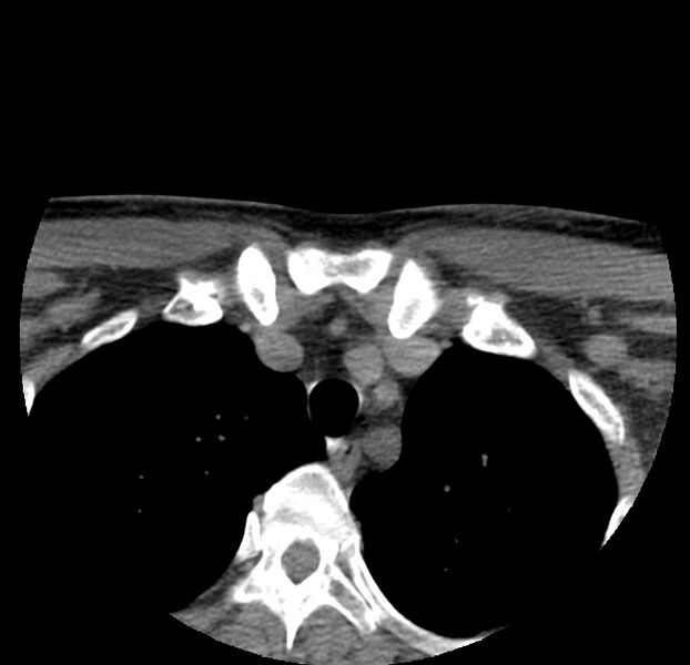 File:Colloid cyst of thyroid (Radiopaedia 22897-22923 Axial non-contrast 57).jpg