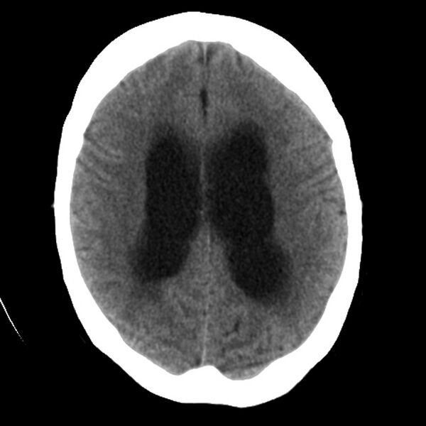 File:Colloid cyst with hydrocephalus (Radiopaedia 9373-10064 Axial non-contrast 13).jpg