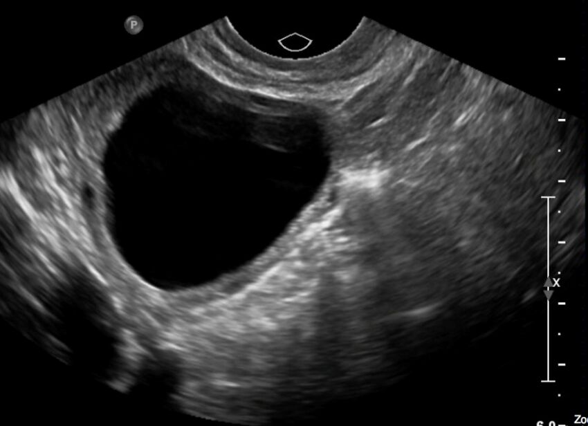 Figure 11.2A Pelvic ultrasound in a female with an ovarian cyst.jpg