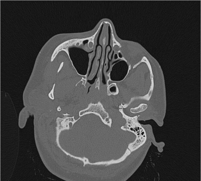 File:Nasolabial cyst (Radiopaedia 25322-25580 Axial bone window 14).jpg