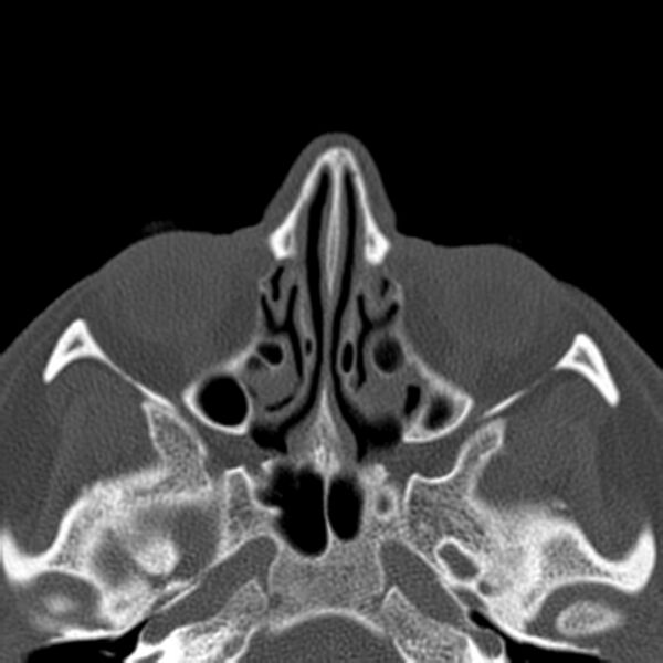 File:Nasolabial cyst (Radiopaedia 33987-35205 Axial bone window 25).jpg