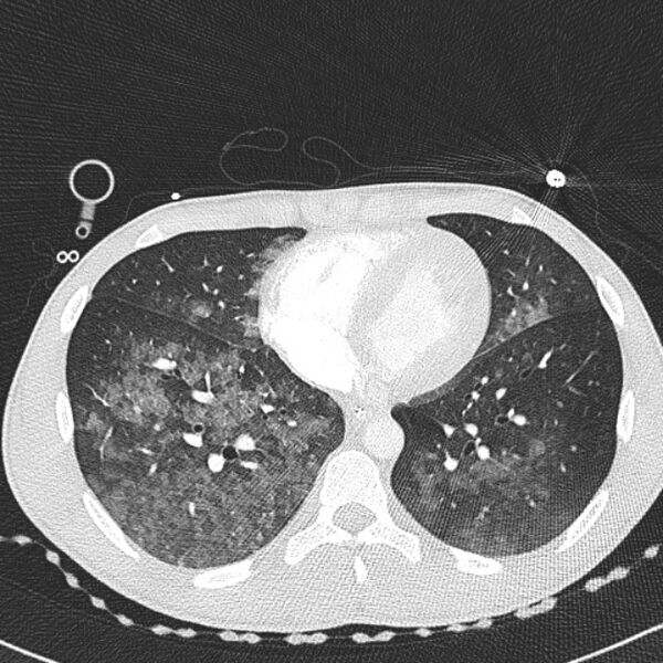 File:Near drowning (pulmonary edema) (Radiopaedia 24685-24958 lung window 51).jpg