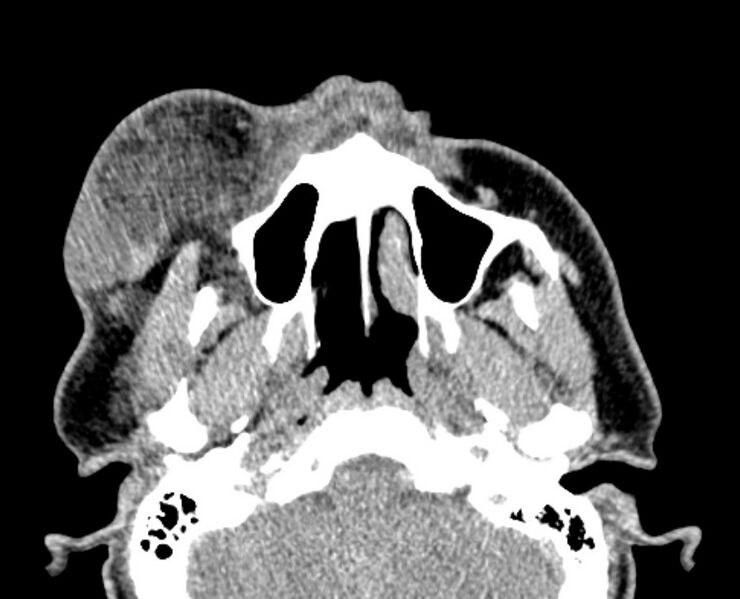 File:Necrobiotic xanthogranuloma- face (Radiopaedia 29549-30052 Axial C+ delayed 10).jpg