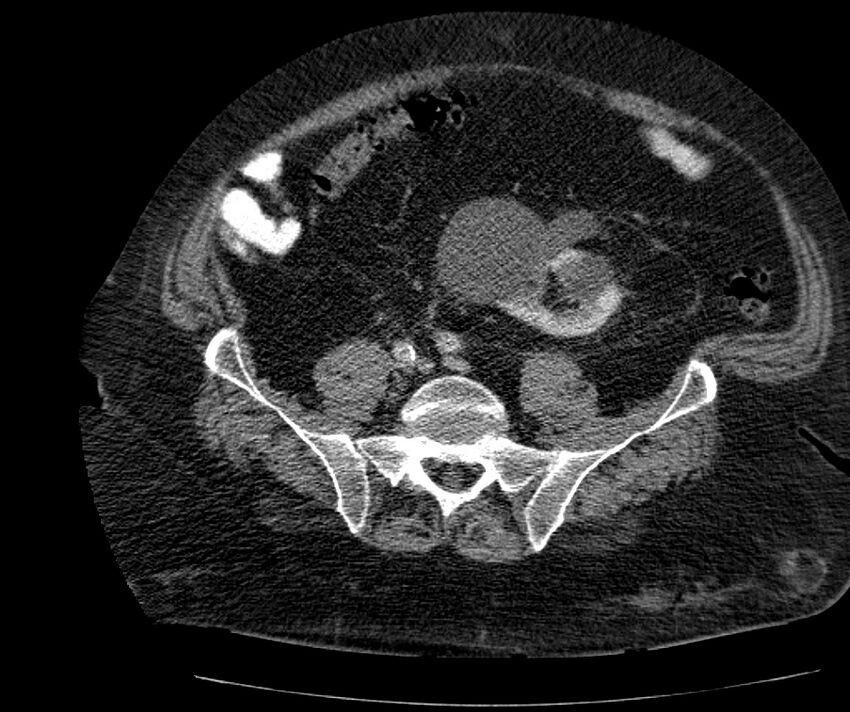 Nephroptosis with inguinal hernia containing perirenal fat (Radiopaedia 56632-63391 C 245).jpg