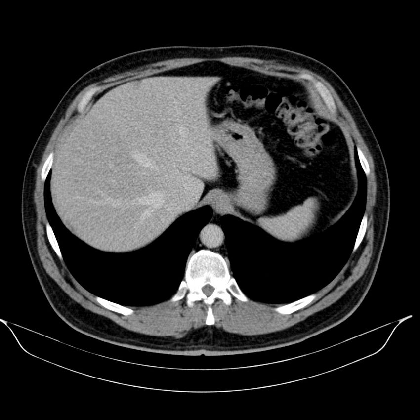 Neuroendocrine tumor of head of pancreas (Radiopaedia 57538-64502 D 16).jpg