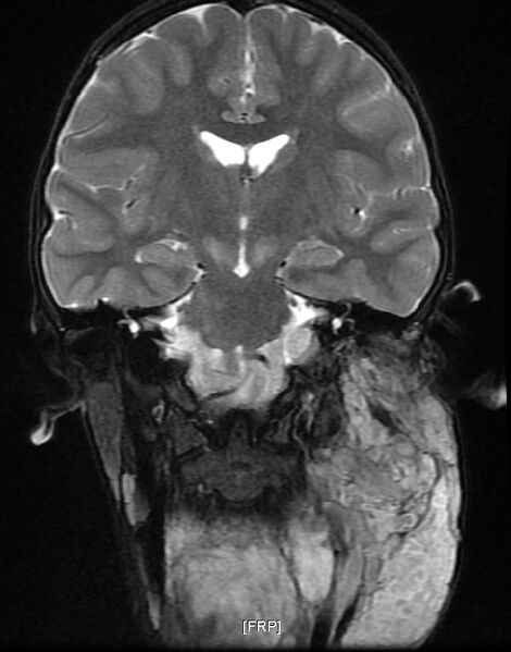 File:Neurofibromatosis type 1 (Radiopaedia 6954-8063 Coronal T2 8).jpg