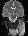 Neurofibromatosis type 1 (Radiopaedia 6954-8063 Coronal T2 8).jpg