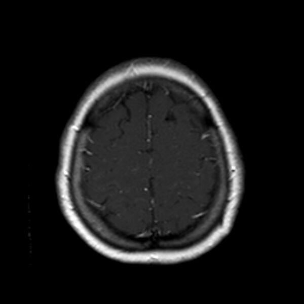 File:Neurofibromatosis type 2 (Radiopaedia 67470-76871 Axial T1 C+ 20).jpg