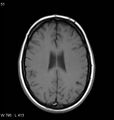 Neurosarcoidosis (Radiopaedia 10930-11351 Axial T1 13).jpg