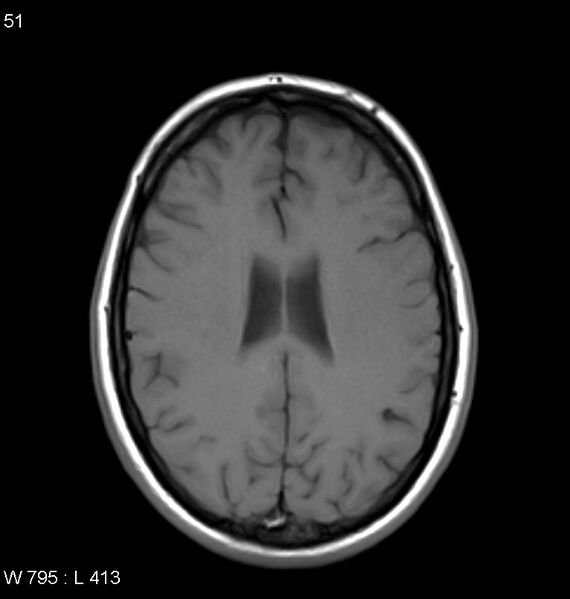 File:Neurosarcoidosis (Radiopaedia 10930-11351 Axial T1 13).jpg