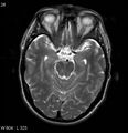 Neurosarcoidosis (Radiopaedia 10930-17204 Axial T2 7).jpg