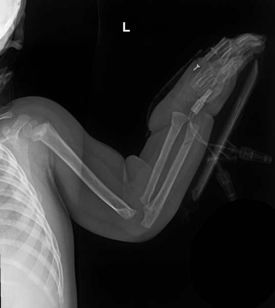 File:Non-accidental injury (Radiopaedia 47998-52792 Left arm 1).png