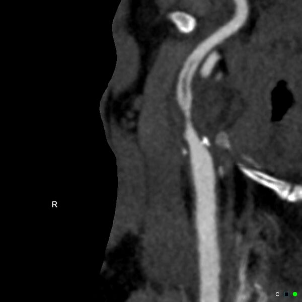 File:Non-occlusive intraluminal internal carotid artery thrombus (Radiopaedia 37751-39658 A 9).jpg