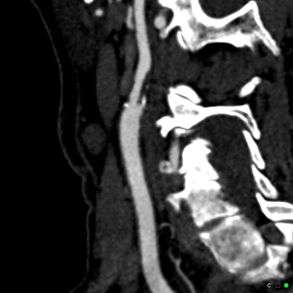 File:Non-occlusive intraluminal internal carotid artery thrombus (Radiopaedia 37751-39658 C 44).jpg