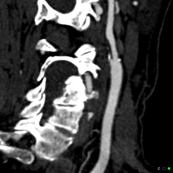 File:Non-occlusive intraluminal internal carotid artery thrombus (Radiopaedia 37751-39658 C 7).jpg