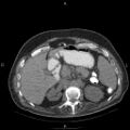 Non Hodgkin lymphoma in a patient with ankylosing spondylitis (Radiopaedia 84323-99624 Axial non-contrast 36).jpg