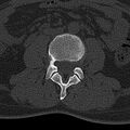 Normal CT lumbar spine (Radiopaedia 53981-60118 Axial bone window 42).jpg