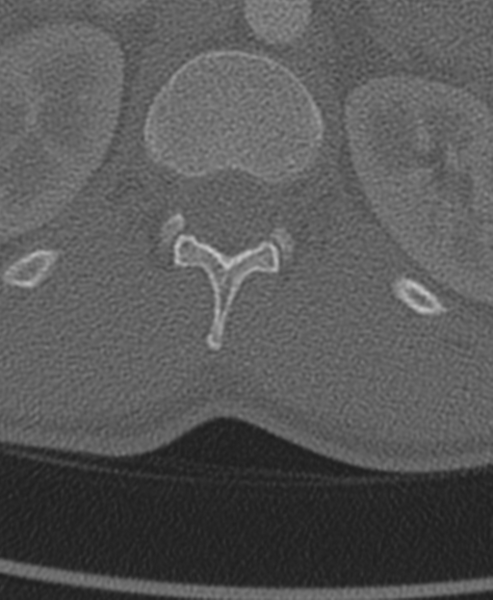 File:Normal CT thoracic spine (Radiopaedia 40181-42688 Axial bone window 104).png