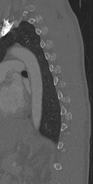 File:Normal CT thoracic spine (Radiopaedia 40181-42688 Sagittal bone window 16).png