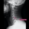 Normal cervical spine radiographs (Radiopaedia 32505-96697 A 12).jpeg