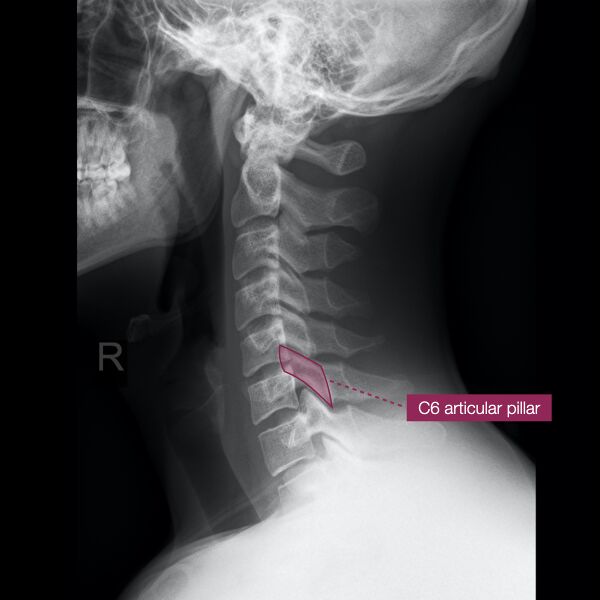 File:Normal cervical spine radiographs (Radiopaedia 32505-96697 A 12).jpeg