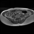 Normal female pelvis MRI (retroverted uterus) (Radiopaedia 61832-69933 Axial T1 2).jpg